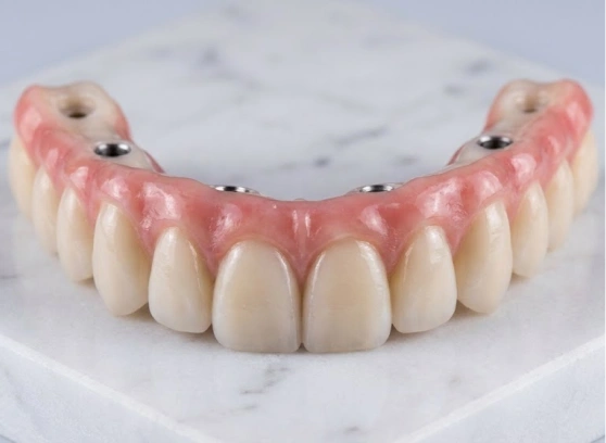 Front view of a premium Zirconia Prettau Bridge, showcasing the natural translucency of a fixed All-on-4 implant denture available at Cancun Dental Design.