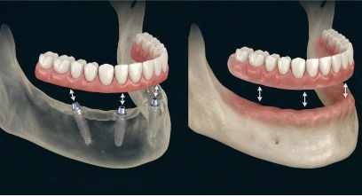 comparison of how an all on 4 is attached to the jaw bone with dental implants versus the traditional denture with nothing to get attached with but denture glue