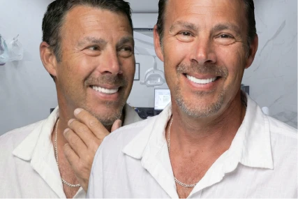 male patient showing a natural smile transformation with 3-on-6 dental implants, highlighting restorative dentistry results.