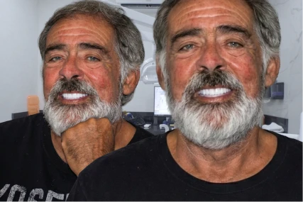 Side-by-side comparison of a senior male patient with a full beard, showing the improved smile and stability achieved with affordable snap-on dentures.