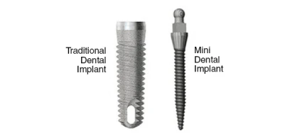 side-by-side size comparison between a traditional dental implant and a mini dental implant
