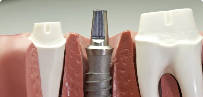 representation of an implant inserted between 2 teeth in a jaw model