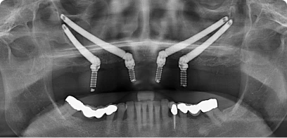 x-ray image of a mouth with 4 zygomatic implants placed in the cheek bone