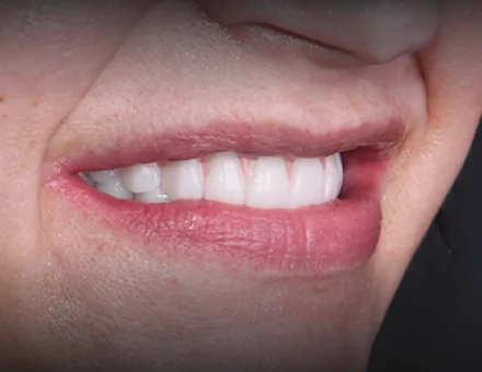 Close-up of the same patient's mouth after All-on-4 dental implants, showing a fully restored, bright, and straight smile.