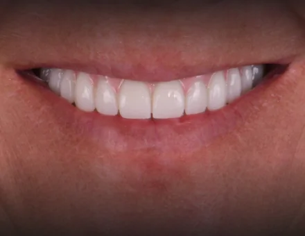 Close-up of the same patient's mouth after 3-on-6 dental implants, showing a fully restored, straight, and bright white smile.
