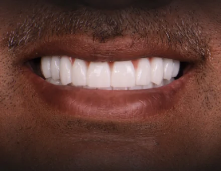 Close-up of the same patient's mouth after 3-on-6 dental implants, showing a fully restored, straight, and bright white smile.