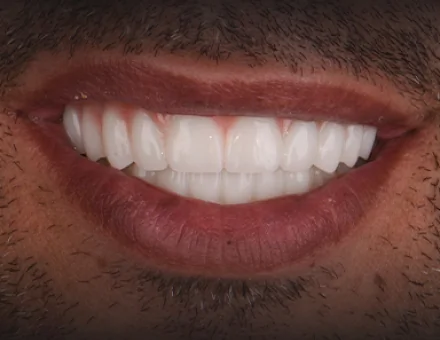 Close-up of the same patient's mouth after a full mouth restoration, showing a complete upper and lower set of straight, bright white restored teeth.
