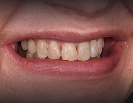 Close-up of patient's mouth before All-on-4 dental implants, showing worn and discolored natural teeth.