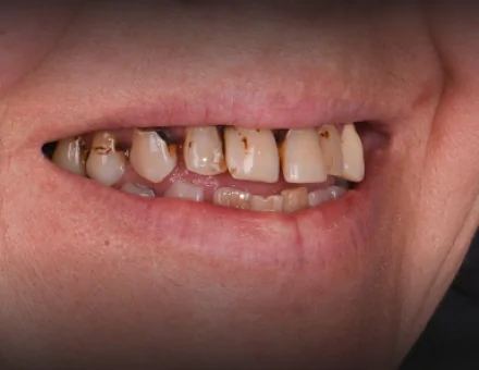 Close-up of patient's mouth before 3-on-6 dental implants, showing severely stained, decaying, and misaligned natural teeth.