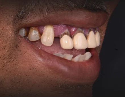 Close-up of patient's mouth before 3-on-6 dental implants, showing a missing tooth, severe decay at the gumline, and damaged natural teeth.