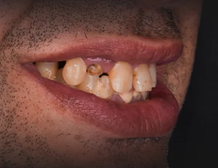 Close-up of patient's mouth before a full mouth restoration, showing missing, chipped, heavily discolored, and decayed natural teeth.
