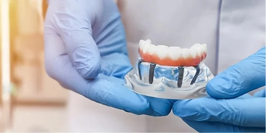 Dentist holding a clear anatomical model of an all-on-4 dental implant supported denture. Showing full arch restoration prosthesis and titanium posts.